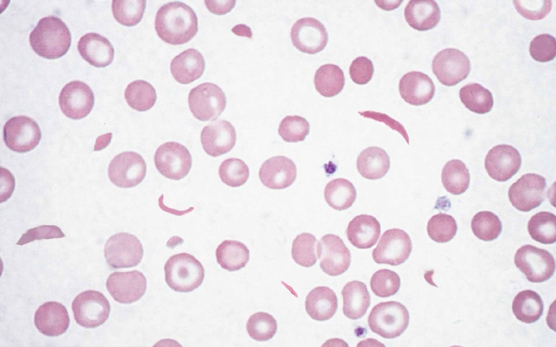 sickle-cell-disease.jpg|150