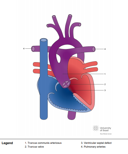 Truncus-communis-arteriosus-Type-I.png|250