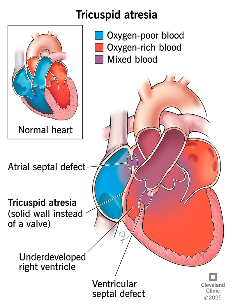 tricuspid-atresia.jpg|200